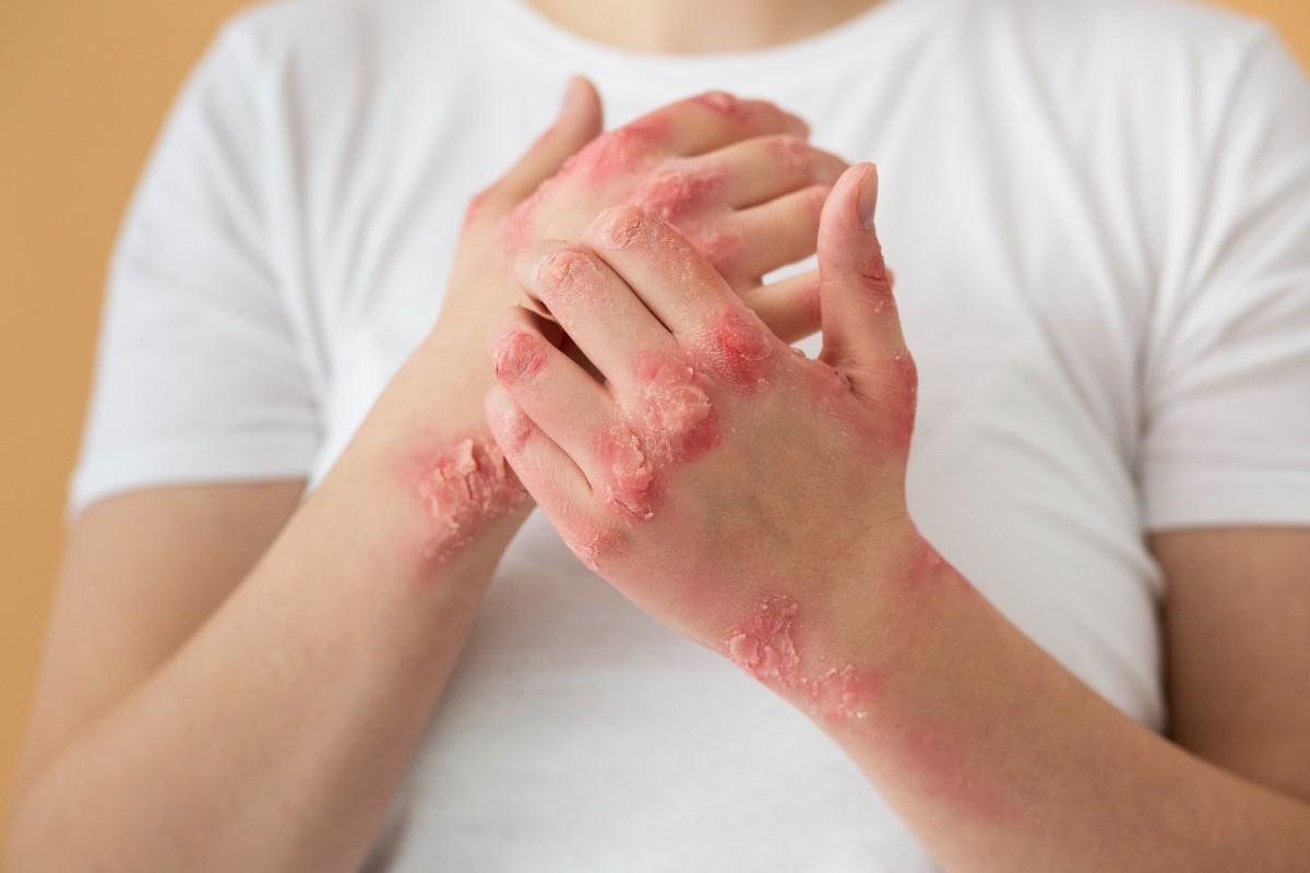 hands patient suffering from psoriasis1