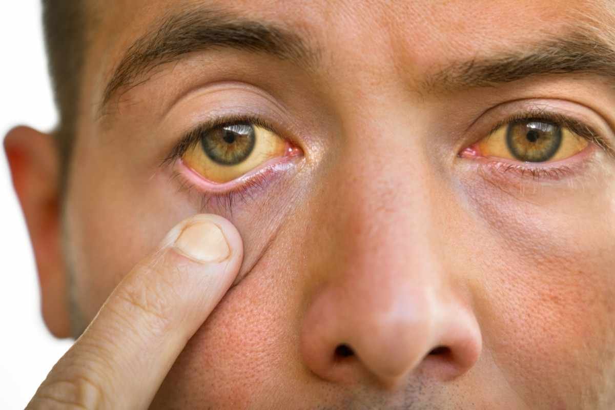 man with yellowish eyes skin symptoms liver disease high bilirubin jaundice hepatitis (1)