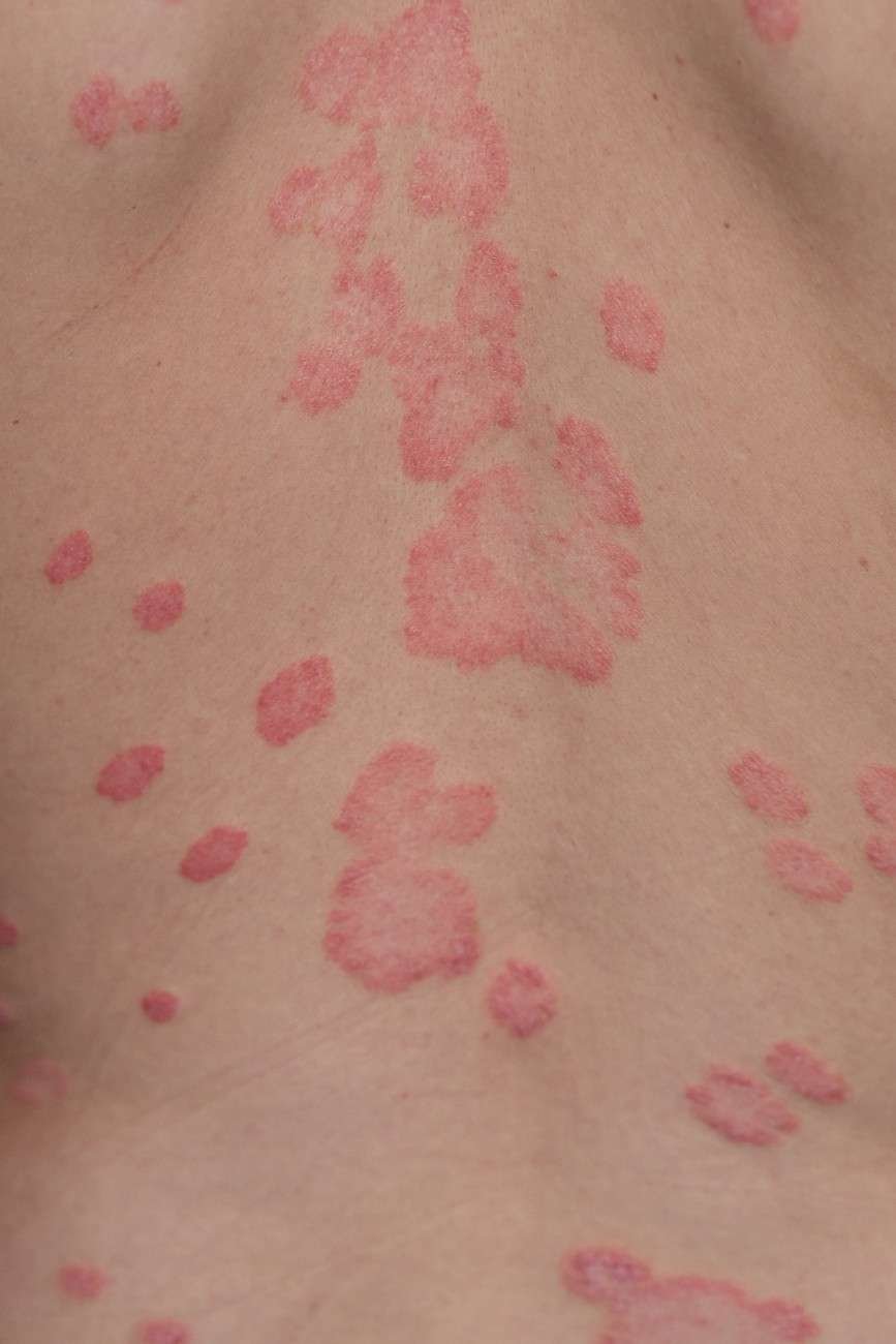 psoriasis vulgaris skin patches are typically red itchy scaly (1)