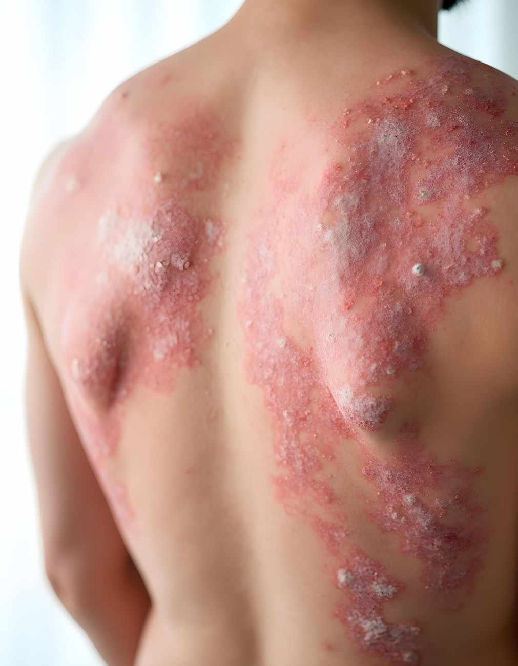 skin condition medical problem psoriasis white background (1)