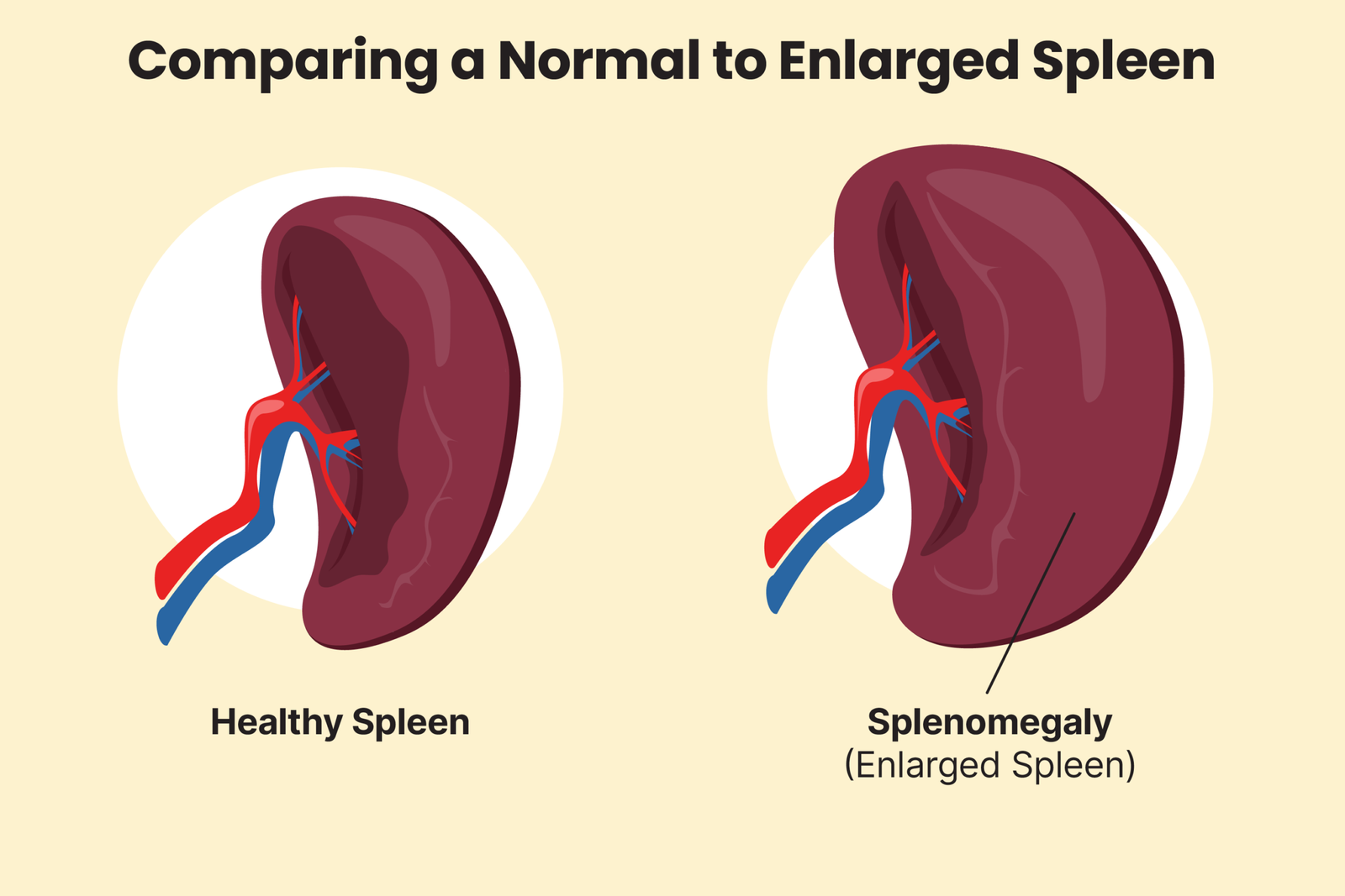 pp gettyimages 1267471541 splenomegaly 3000x2000