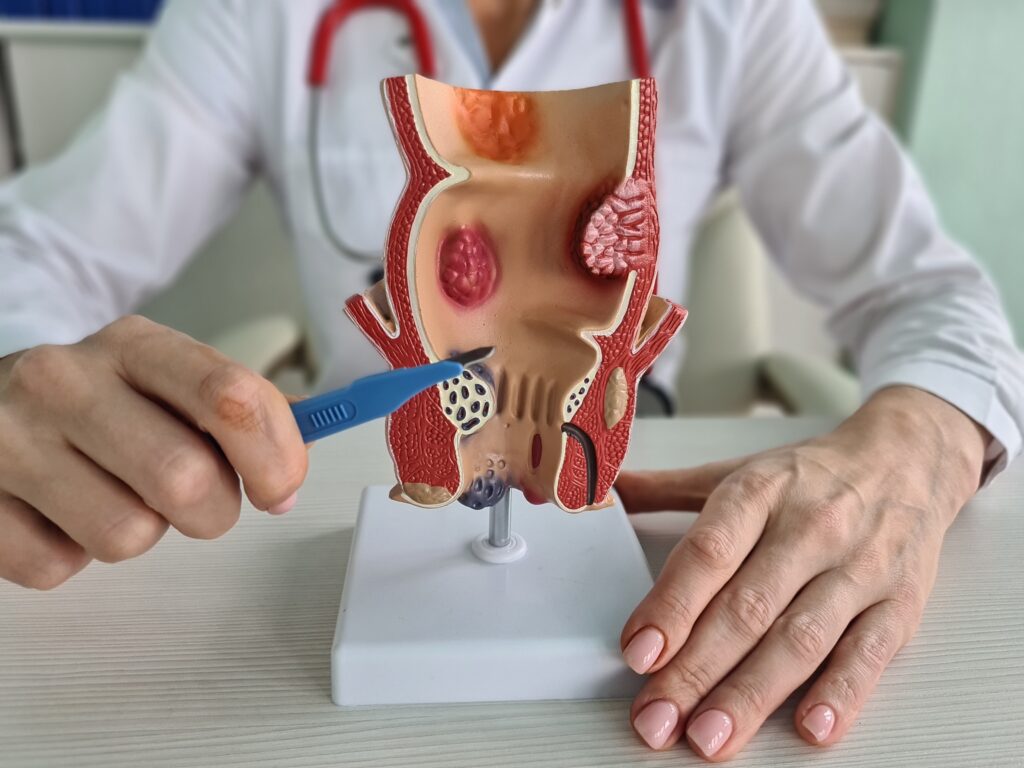 Ayurvedic Treatment for Piles in Aligarh
Treatment for Piles in Aligarh