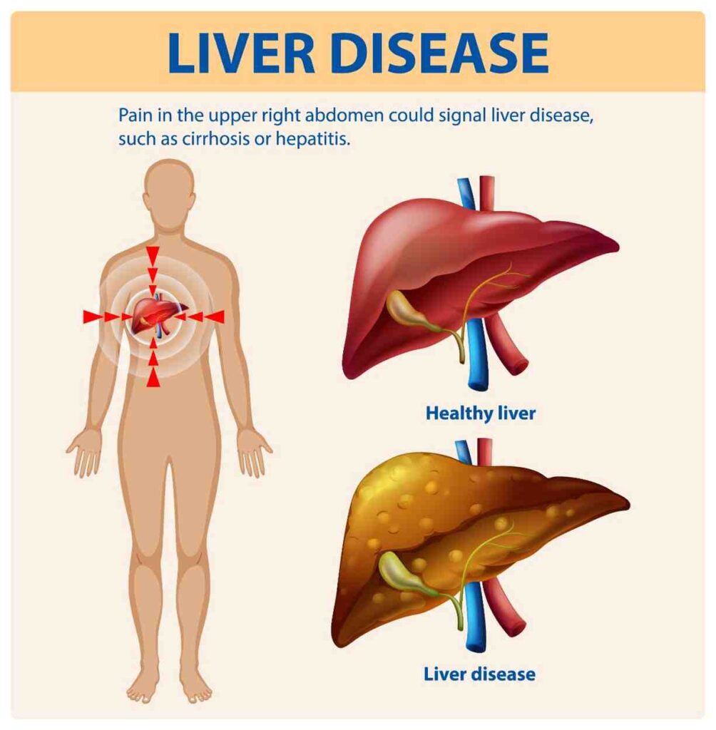 Fatty liver vs healthy liver diagram showing symptoms and liver disease in right abdomen Fatty Liver Ayurvedic Treatment