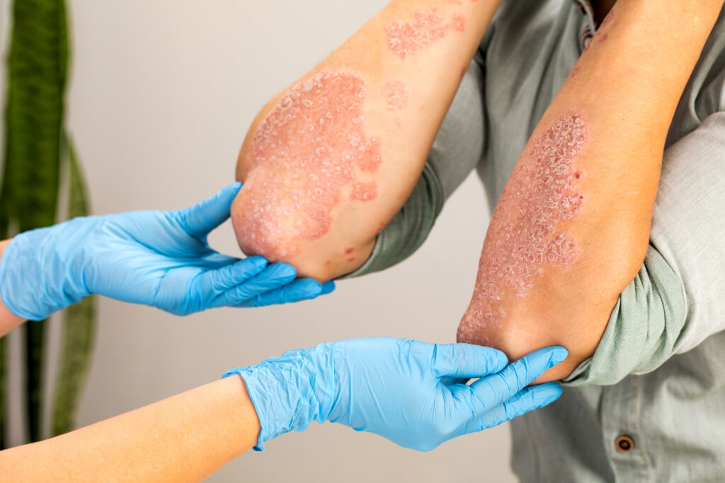 eczema skin rash on elbows dermatologist examination. eczema treatment in Aligarh