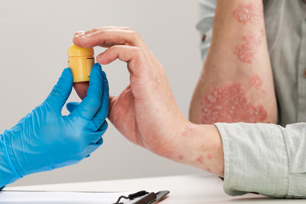 Ayurvedic treatment for psoriasis