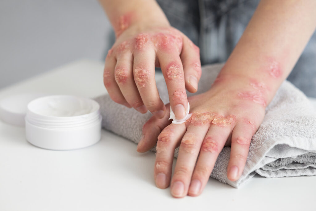 eczema treatment in Aligarh